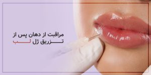مراقبت از دهان پس از تزریق ژل لب